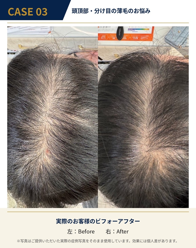 発毛施術の症例3