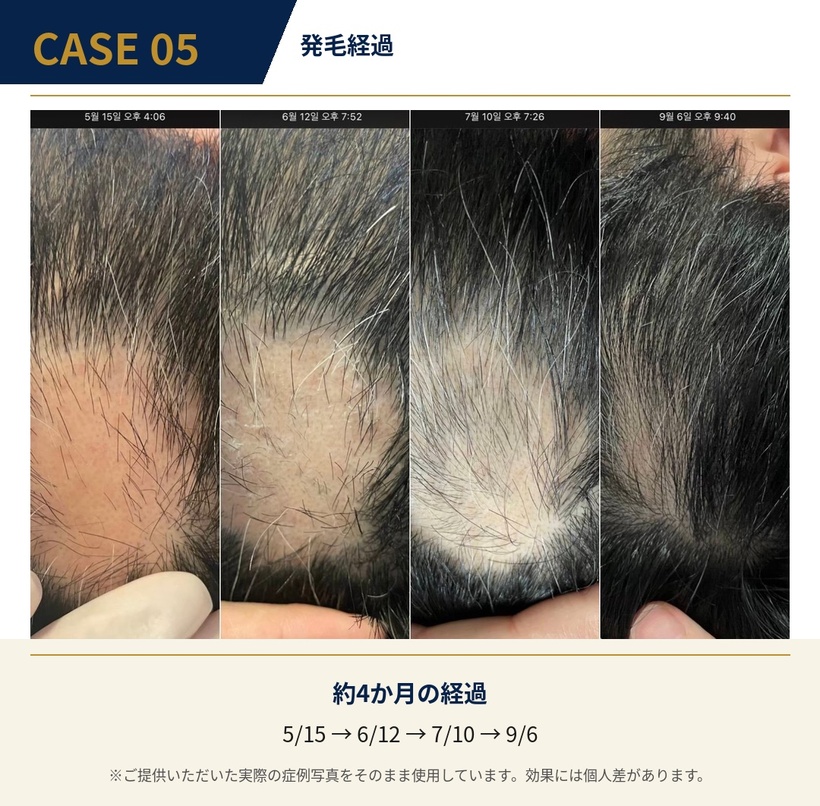 発毛施術の症例4